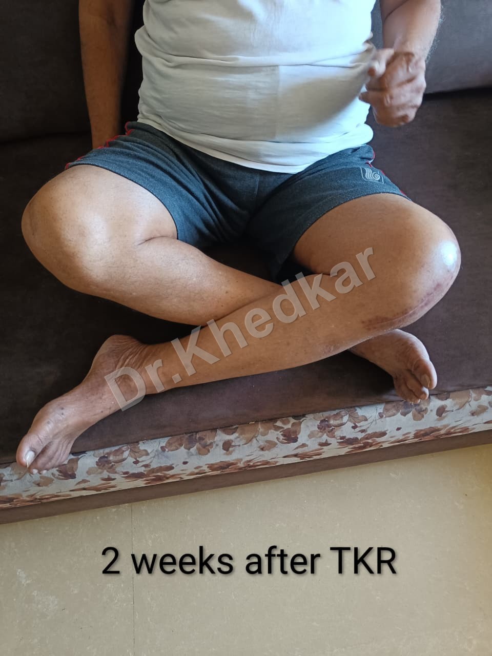 TKR Procedure Thumbnail